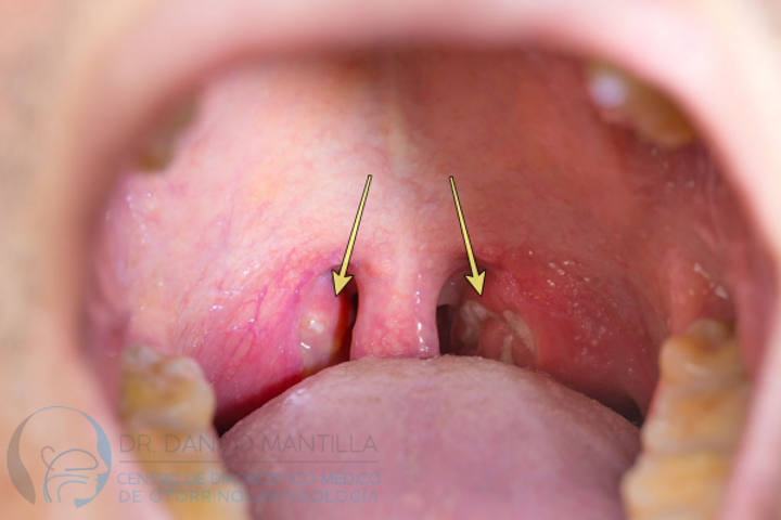 Amigdalitis Dr Danilo Mantilla Orl Diagnóstico Y Tratamiento Quito Ecuador