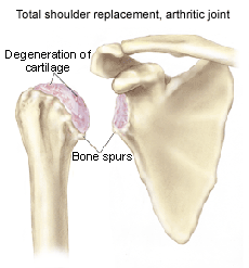 1.-shoulder_arthritis.gif