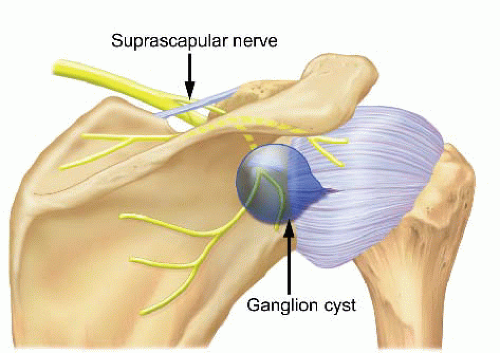 spinoglenoidcyst.gif