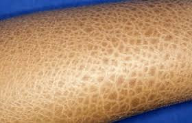 Ichthyosis
