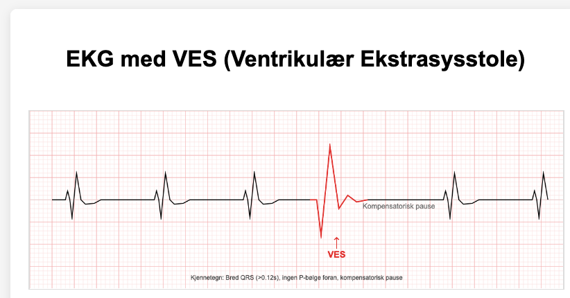 VES er ekstraslag som kommer fra hjertekammer. Et fåtall VES er normalt hos friske mennesker.