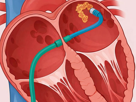 Catheter Ablation for Atrial Fibrillation: Risks, Complications, and Safety Profile