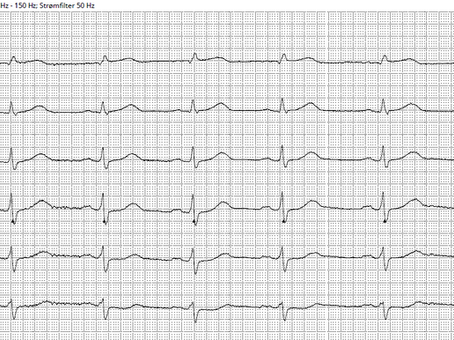 Circumflex Artery Myocardial Infarction: When Acute Coronary Occlusion Does Not Meet STEMI Criteria on ECG