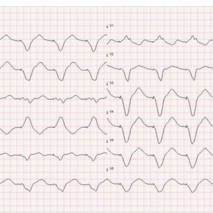 Incessant ventrikkeltakykardi hos pasient med CRT-D: klinisk kasuistikk, EKG-diagnostikk og praktiske læringspunkter - Del 1