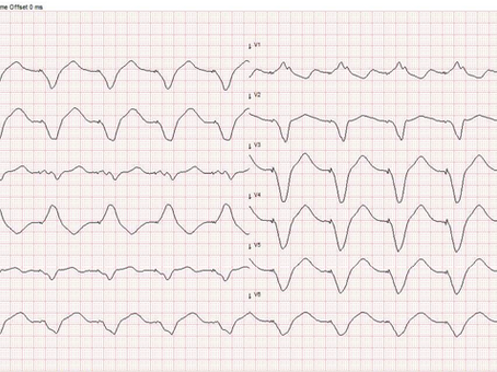 Slow Ventricular Tachycardia and Electrical Storm in a CRT-D Patient: A Clinical Case and Diagnostic Pitfalls - Part 1