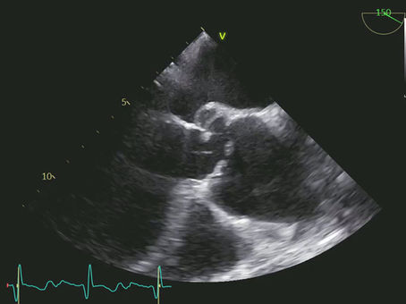 When a Urinary Tract Infection Does Not Explain Bacteremia. A Case Report of Sepsis, Klebsiella pneumoniae, and Missed Infective Endocarditis