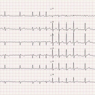 Atrieflimmer forklart: urolig puls, EKG-funn og behandling i praksis