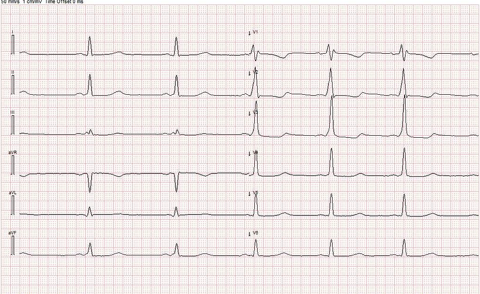 Sinusrytme. PQ-tid 106 ms. Deltabølger.