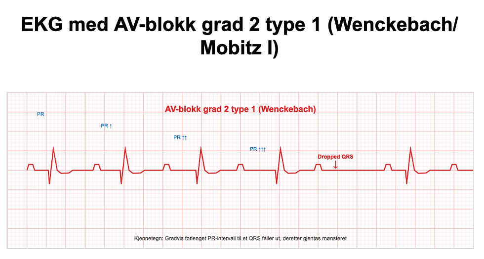 Langsom hjerterytme som følge av treg ledningsystem - forekommer som oftest hos de eldre.