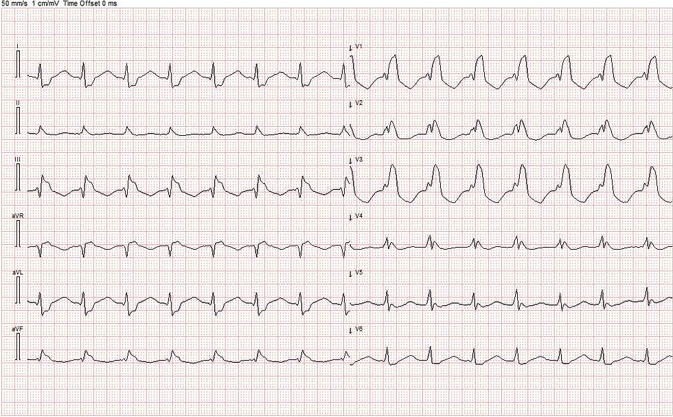 Kjent høyregrenblokk. Frekvens 182/min. Ingen sikre p-takker