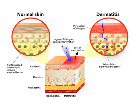 Images of normal skin and skin affected by dermatitis
