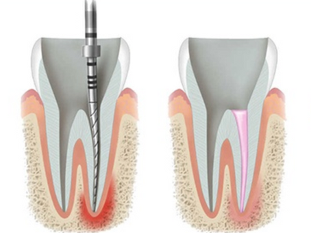 Root Canal Therapy: Saving Your Natural Tooth