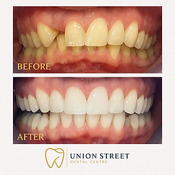 Teeth Whitening Results