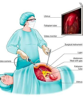 Laparoscopy.jpeg