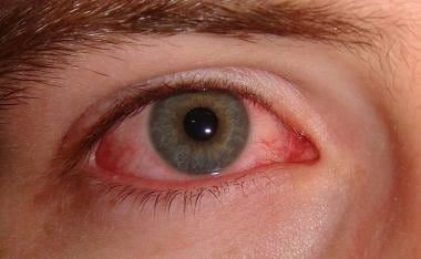 Eye Flu- What you need to know