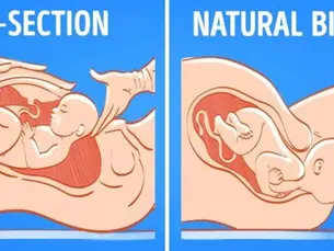 C-Section Recovery vs. Vaginal Birth Recovery: What’s Different?