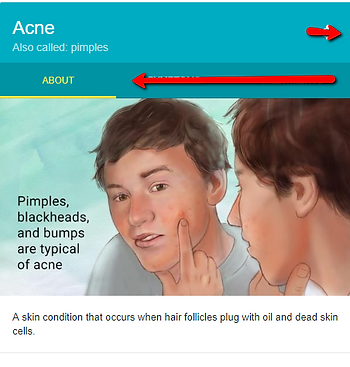 Acne