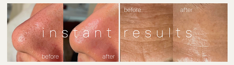 Hydrafacial Instant results (1).png