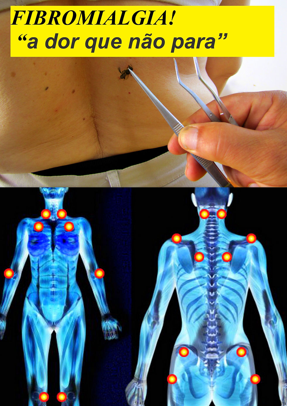 fibromalgias