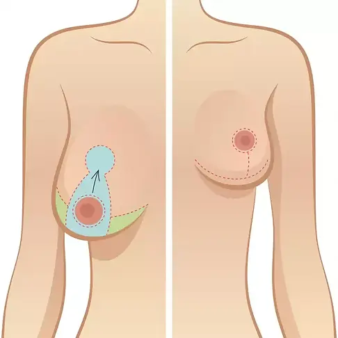 Breast Lift.webp