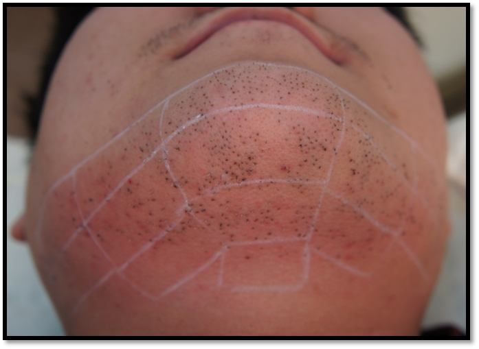 ภาพขนาดย่อ: Laser Hair Removal เลเซอร์กำจัดขนถาวร