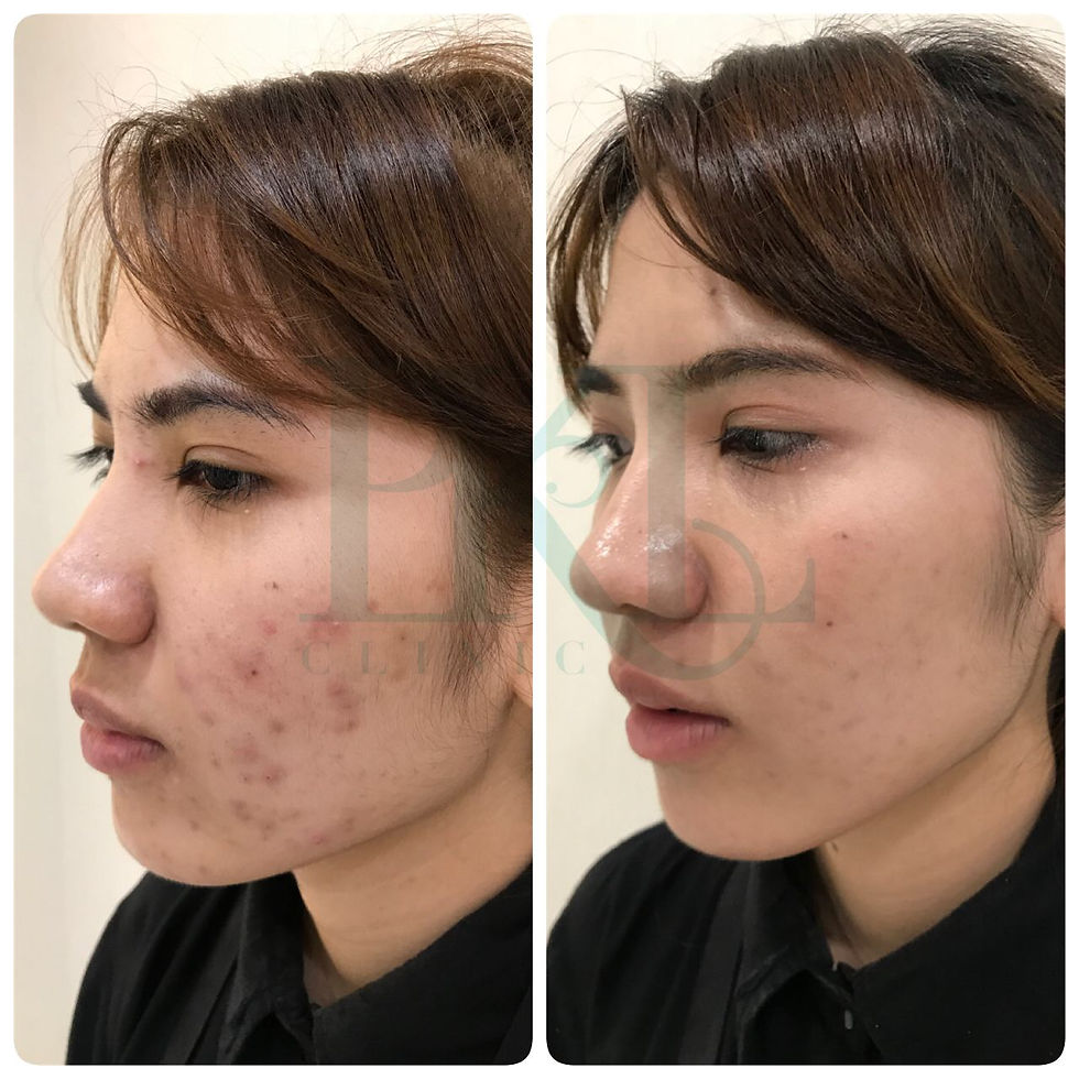 Thumbnail: Acne Program