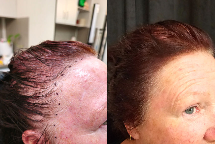 efore and after SMP on woman in her 50s with reddish hair, restoring density to temples and hairline