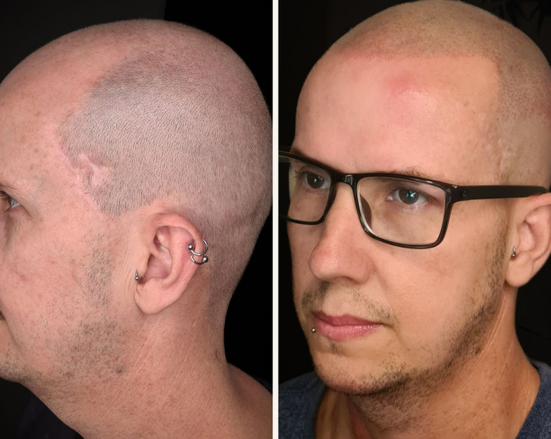 Before and after SMP on male client with horseshoe baldness, showing full buzzcut look