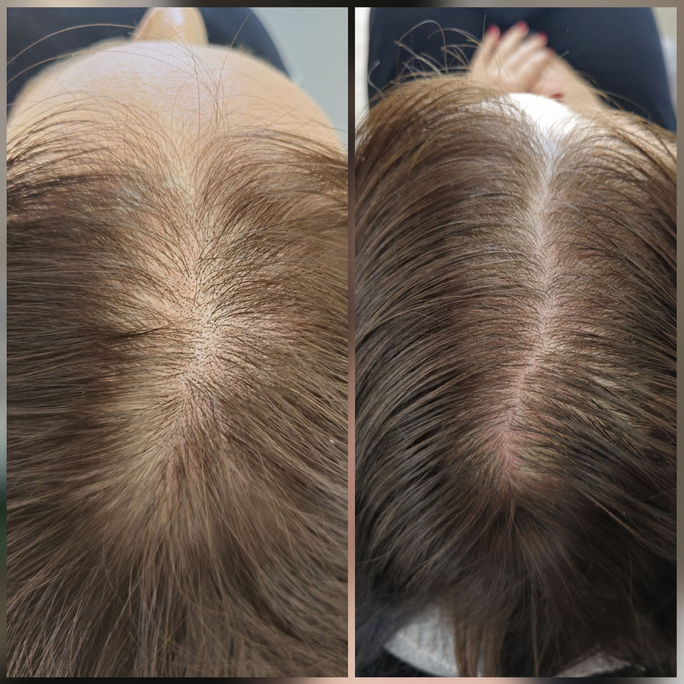 Top-down before and after photo of female SMP treatment for part line thinning