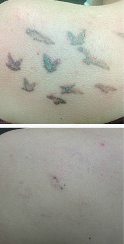 Post 8 treatments