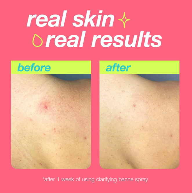 Thumbnail: Clarifying Bacne Spray