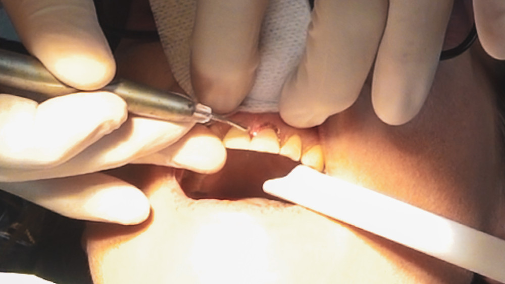 Natural Kaos Lasering Gums