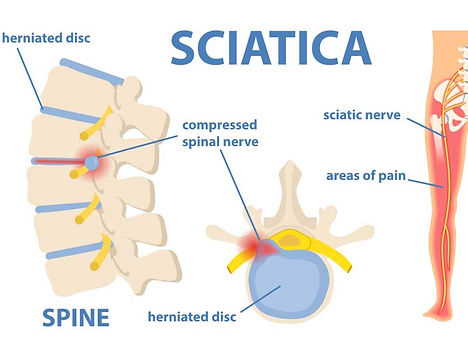 Physiotherapy-and-Chiropractic-Treatments-for-Sciatica-Pain.jpg