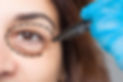 Small-Article-WhatIsEyelidSurgery.jpg