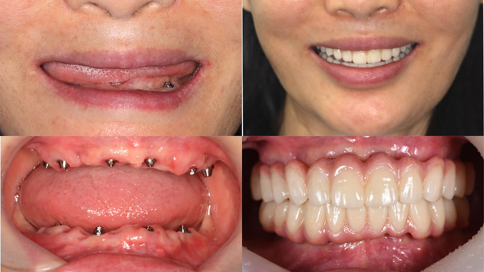 Full-Arch Rehabilitation Using Multi-Unit Abutments and Same-Day Provisionalization