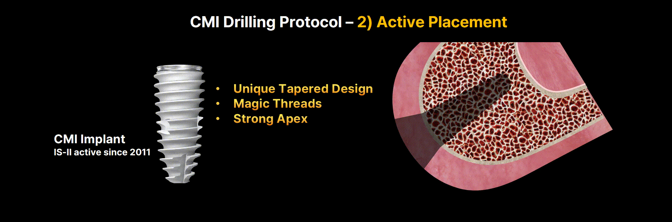 Active Placement for Soft Bone