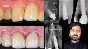 Beyond the Implant: Achieving Gingival Harmony Through Strategic Prosthetic Refinement