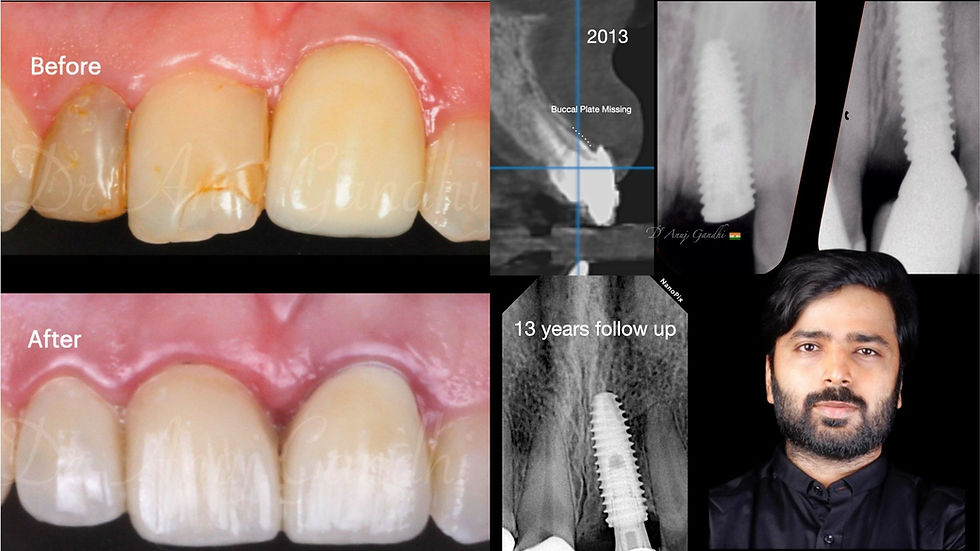 Beyond the Implant: Achieving Gingival Harmony Through Strategic Prosthetic Refinement