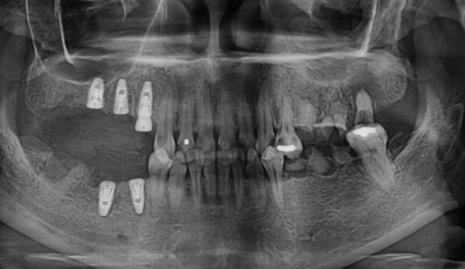 Panoramic radiograph