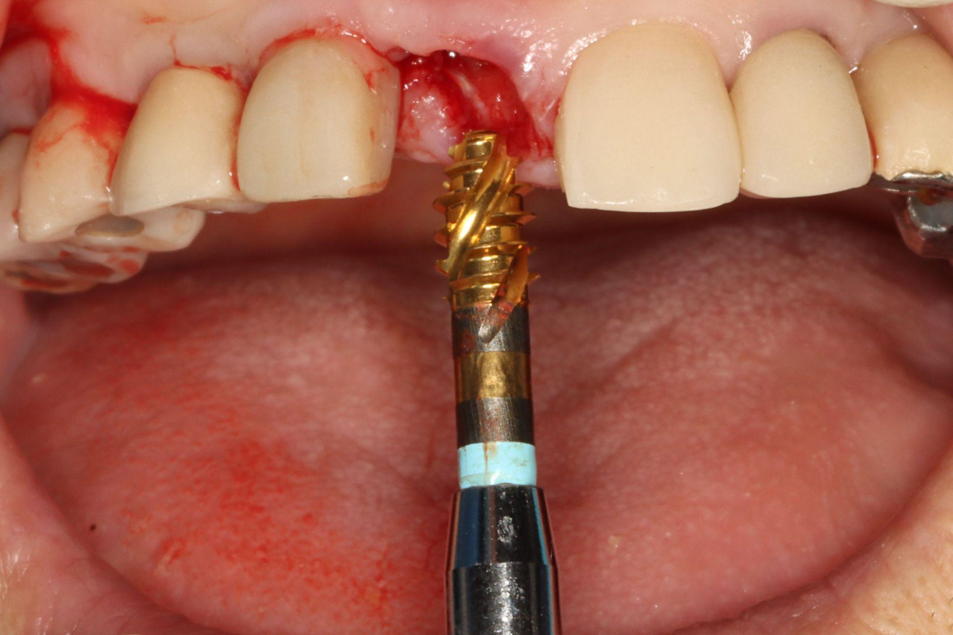 Ø4.5 MAXY drill was used to finalize site preparation, matching the planned implant depth.