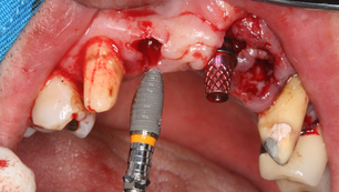 Esthetic restoration in the anterior maxilla