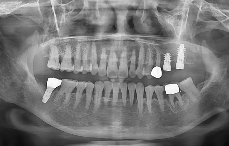 ALX implant