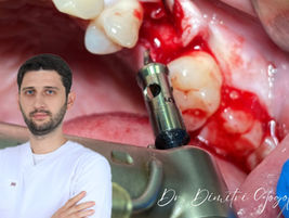 Using the SCA Kit and NeoBiotech Implants: A Clinical Case Report