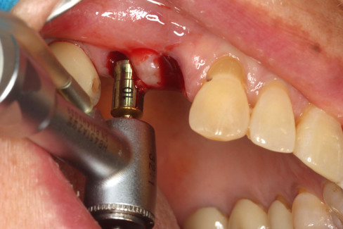 S-reamer with a 10mm stopper used at site #15 to safely control the depth during crestal sinus elevation.