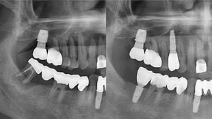 A 9-Year Longitudinal Follow-up of IS-III Implants: Clinical Outcomes from 2017 to 2025
