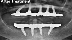 NEO-NAVIGUIDE usage in compromised bone width of All-on-4 case with NEOBIOTECH implant