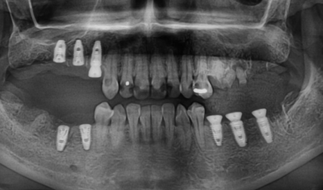 Panoramic radiograph