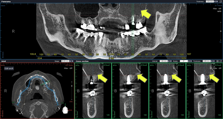 Initial CBCT