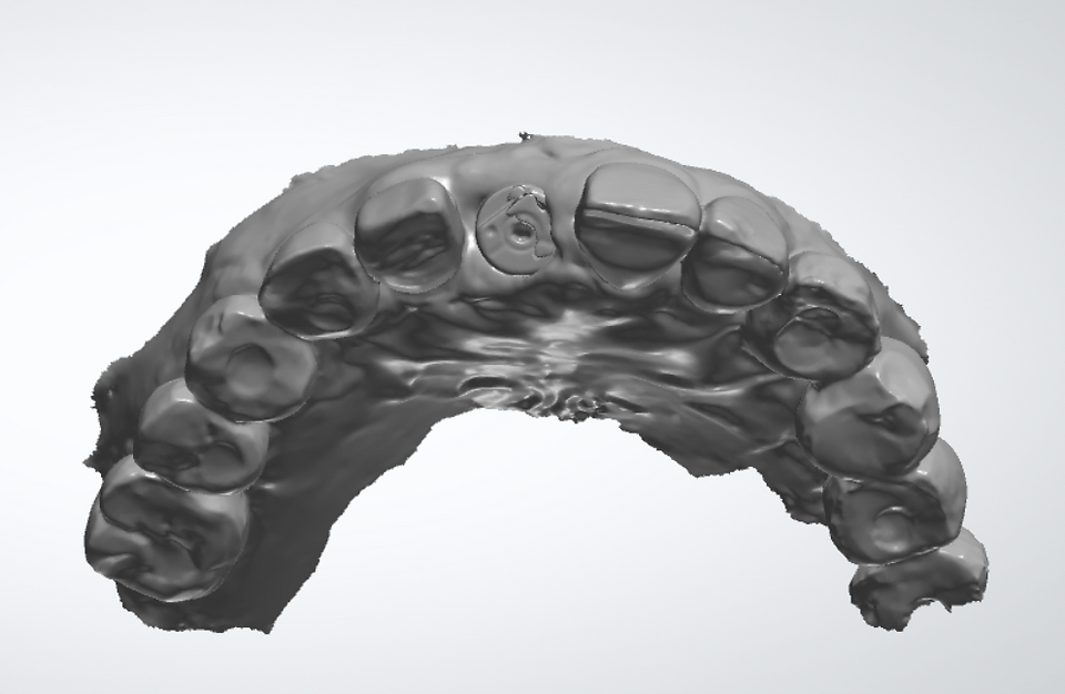 intraoral scanning image