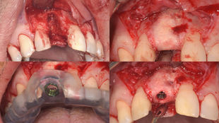 Guided Implant Placement in the Anterior Maxilla After GBR Retreatment